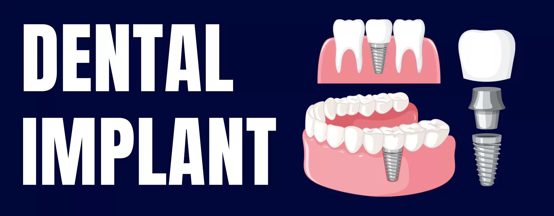 Dental İmplant (Diş İmplantı)