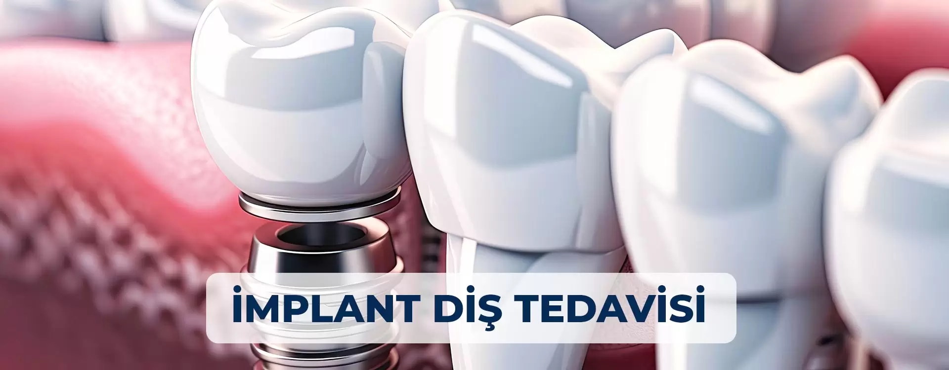 İmplant Diş Tedavisi