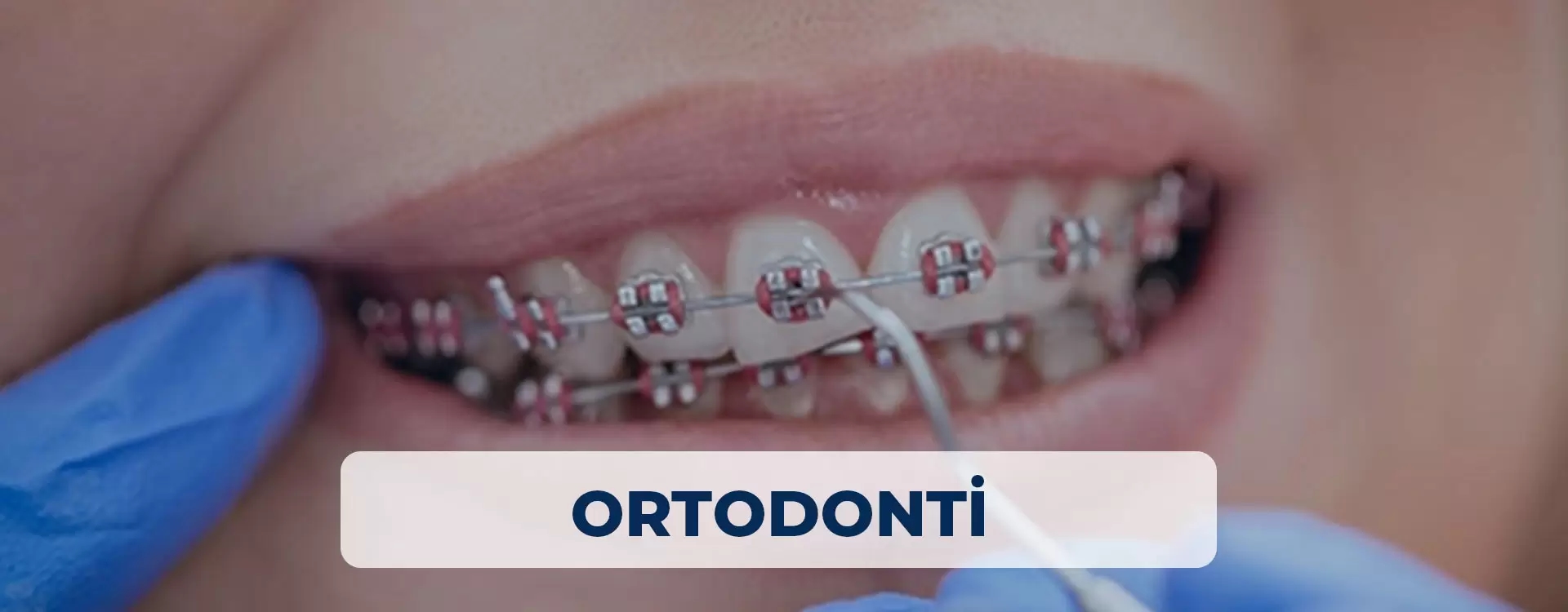 Ortodonti Tedavileri