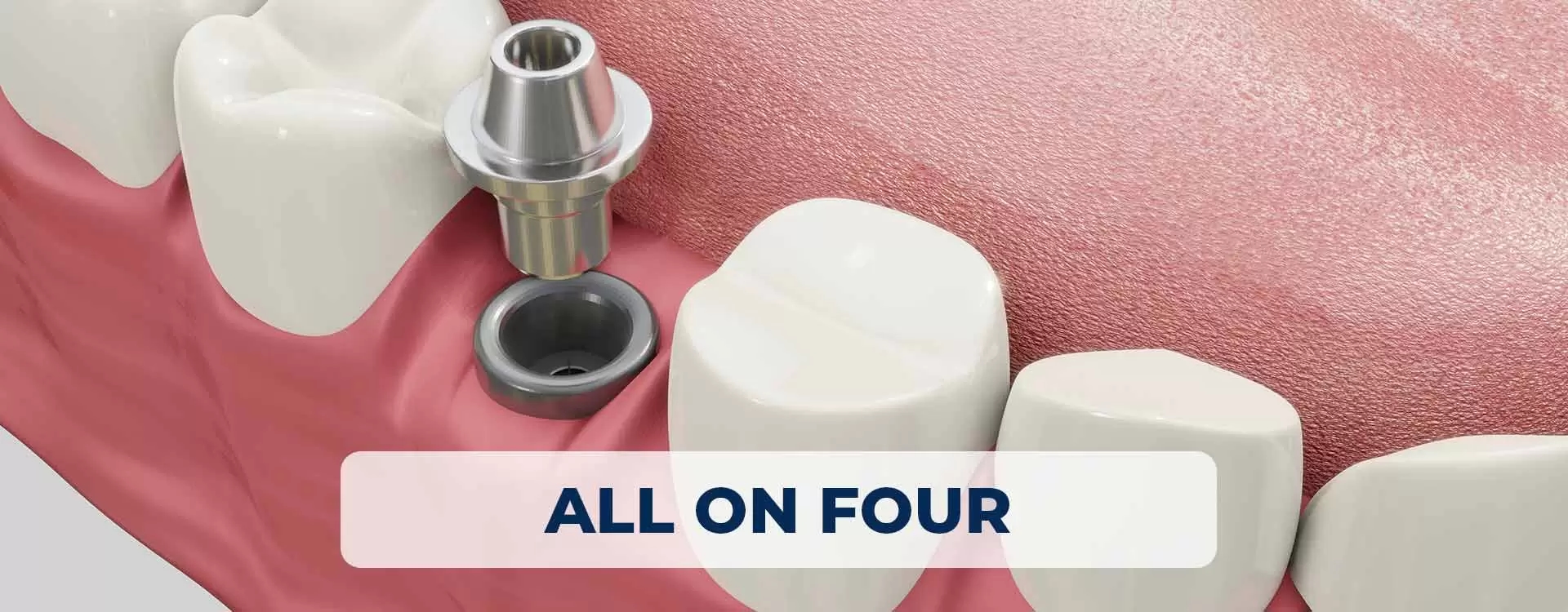 All On Four İmplant