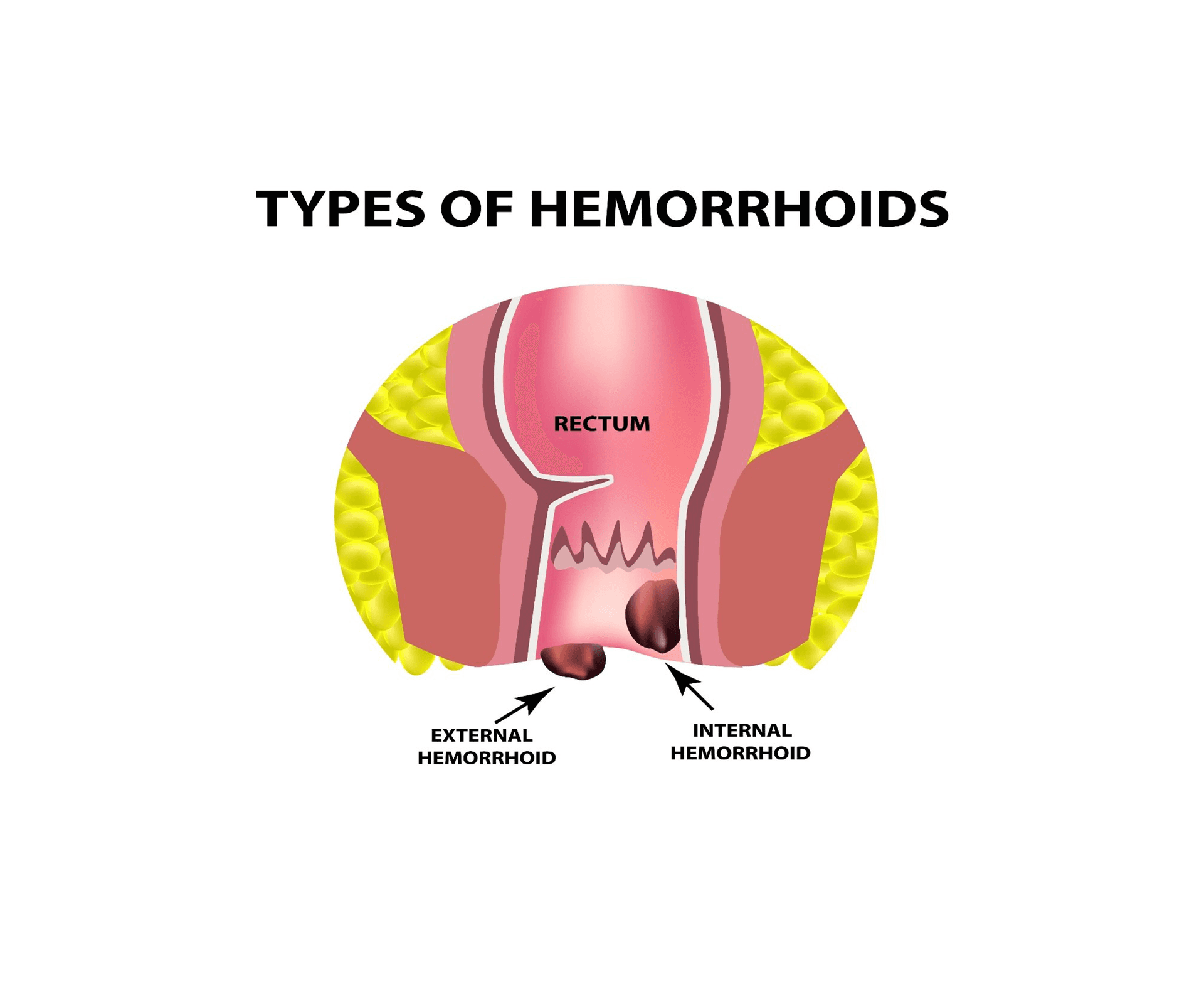 Hemoroid: Sessizce İlerleyen Rahatsızlık hakkında detaylı bilgi ve tedavi yöntemleri Hemoroid: Sessizce İlerleyen Rahatsızlık - Medibul sağlık rehberi uzman bilgilendirme makalesi